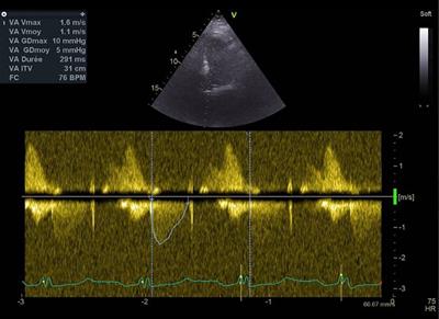 Bioprosthetic valve thrombosis after transcatheter aortic valve replacement and pulmonary embolism due to heparin-induced thrombocytopenia: a case report